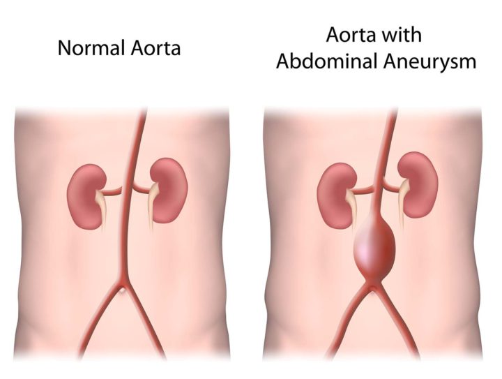 abdominal aneurysm image