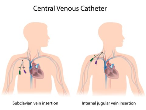 Central venous cathetar
