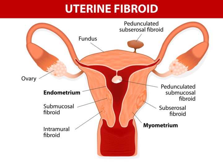 uterine fibroid image