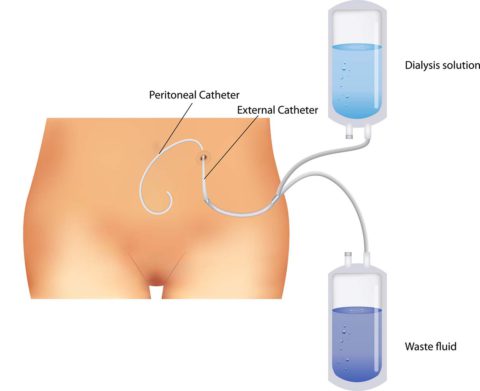 Peritoneal Catheter