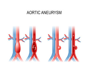 aortic aneurysm image